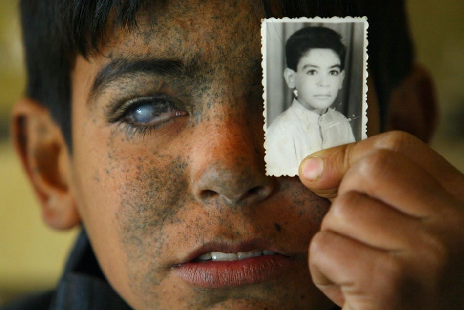 Ayad Alim Brissam Karim, egy amerikai légitámadásban maradandó sérüléseket szenvedett iraki fiú